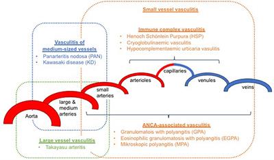 Childhood Vasculitis